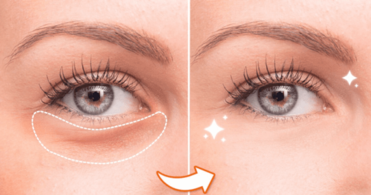 Innovative eye bag treatments, strengthening collagen response, for long-term aesthetic stability