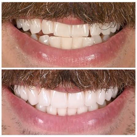 The Case That Already Has Veneers