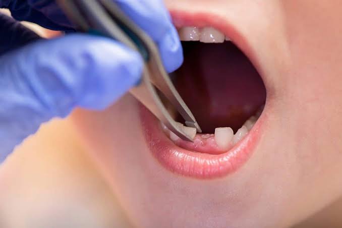 Signs Your Child May Need a Tooth Removed and What Comes Next